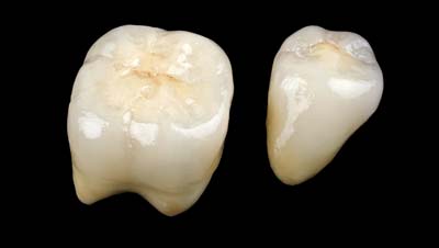 bigstock-Ceramic-Crowns-51567442